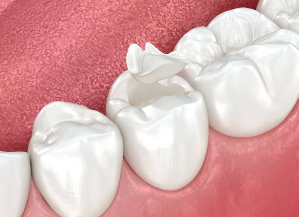 Best Dental Fillings (Composite and Amalgam)  in Vinton, IA